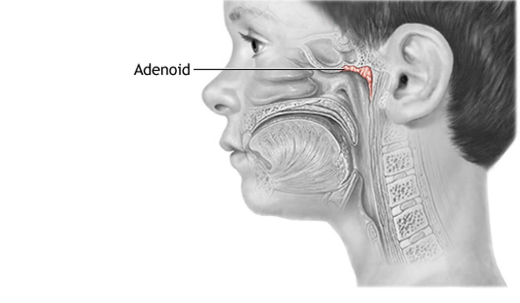 Adenoidectomy - Dr. Dawie van Staden | ENT Surgeon Kempton Park